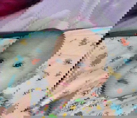 Mata ujung bayi lecet akibat suka digaruk