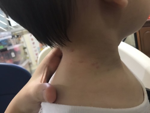 Insect Bites?