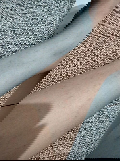 gatal-gatal di kulit