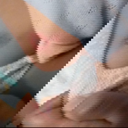 Penyakit kulit pada bayi