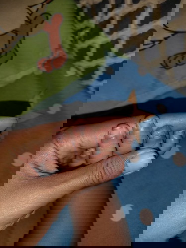 สอบถามแม่ๆหน่อยค่ะ นิ้วมือน้องเป็นแผลแบบนี้ ต้องทำยังไงค่ะ ไปหาหมอมาแล้วแต่ยังไม่หาย