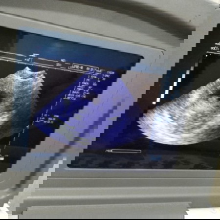 BINGUNG HPHT beda jauh dengan USG 🥺