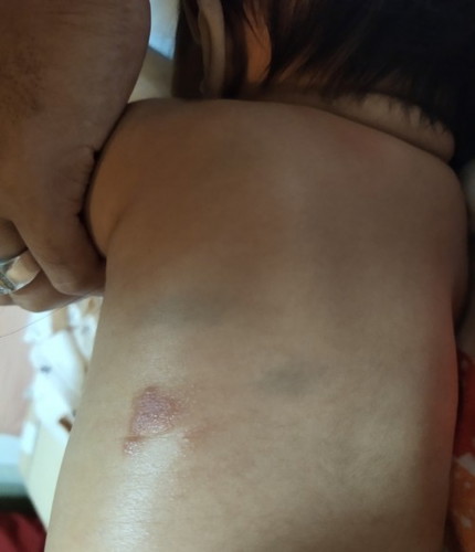 อาการผื่นเเดงที่ตัวลูก