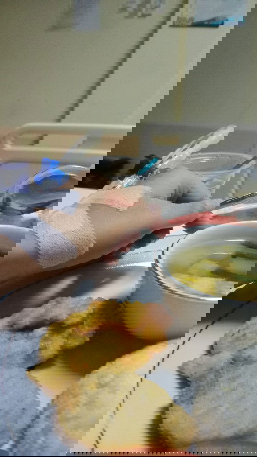 kista bartholin hamil 10 weeks