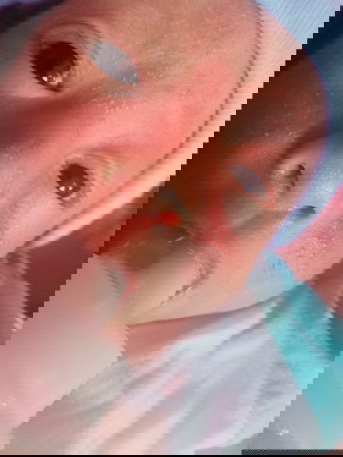 น้องเป็นผดผื่นที่หน้าแบบนี้ใช้ยาหรือครีมตัวไหนดีคะที่จะรักษาให้หาย