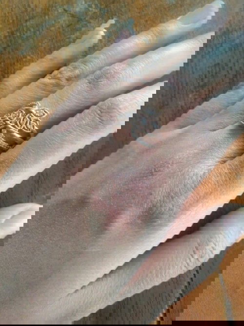 Gatal gatal di tangan,