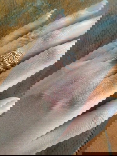 Gatal gatal di tangan,