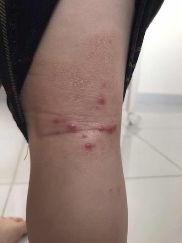 Insect Bites