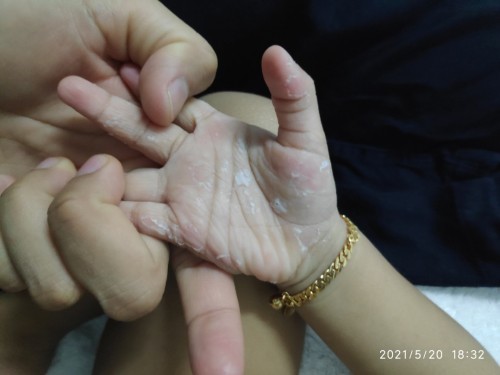 Tangan anak menggelupas