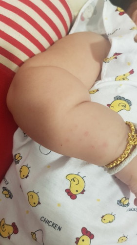 ลูกน้อยมีอายุ 3 เดือน 9 วันมีผื่นแดงๆขึ้นตามตัว ไม่ทราบว่าเป็นผดร้อนหรือเปล่าคะ มีลูกใครเคยเป็น.