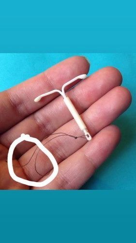WHO'S IUD USER HERE?