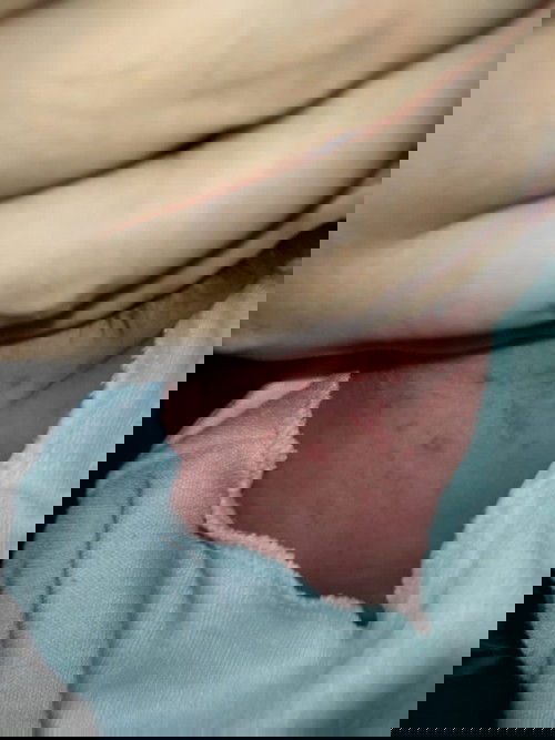 Cara atasi biang keringat