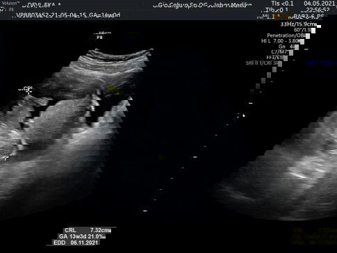Cara membaca hasil USG 2D