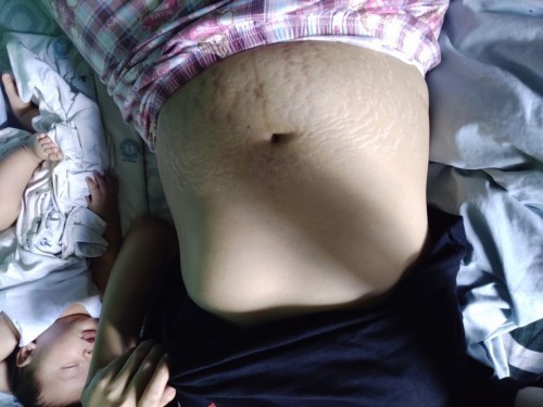 Stretch marks