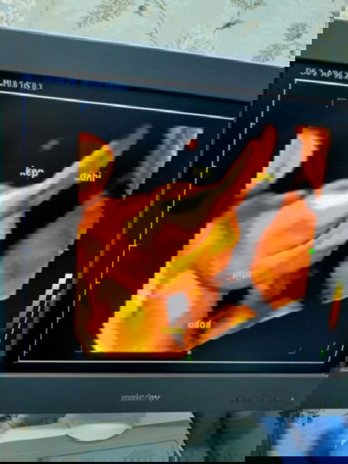 Cairan ventrikel janin