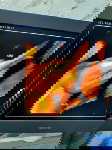 Cairan ventrikel janin