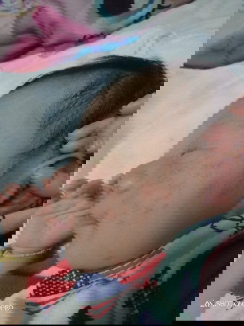 บ้านไหนหน้าและตัวลูกเป็นเม็ดแดงๆบ้างค่ะ