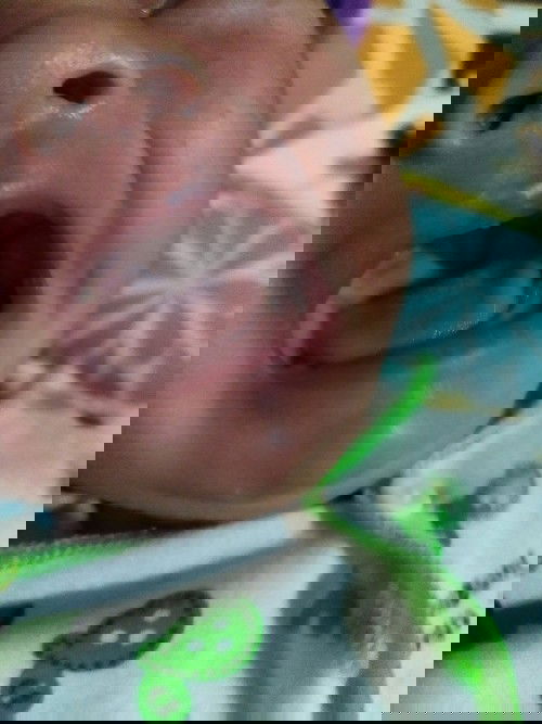 banjolan pada gusi bayi