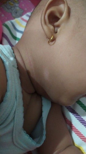 bagaimana menghilangkan bercak putih pada bayi