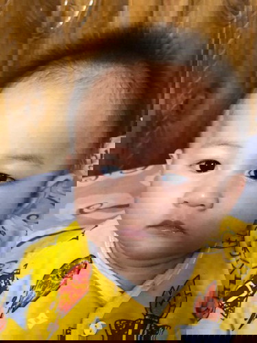 Mata Bengkak pada bayi