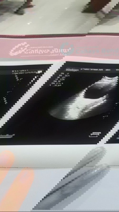 Mau tanya perihal usg,skrg usia 7w 5h