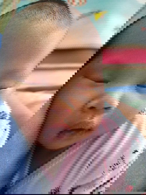 Urat pembuluh darah mata menonjol