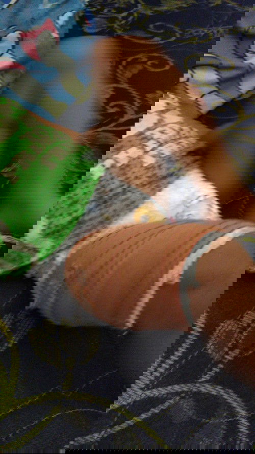 Sedikit RetaK tulang paha pada anak