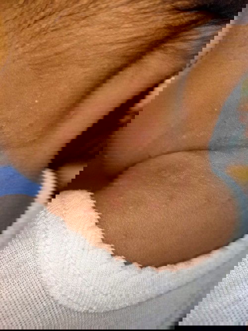 Apakah ini Cacar air?