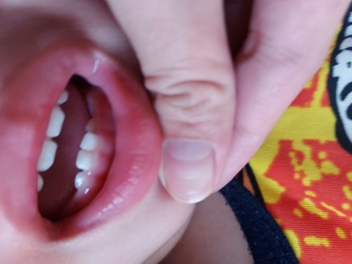 ฟันผุของลูกน้อย🦷