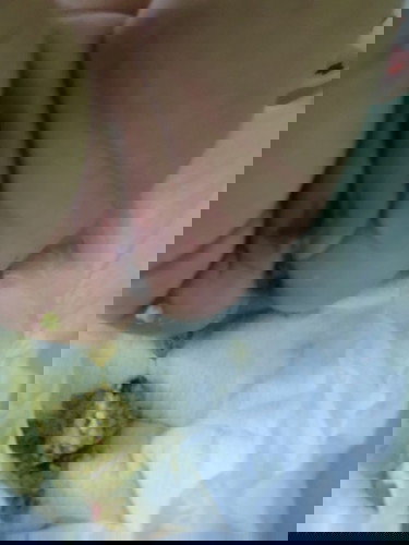 มีเลือดออกเป็นมูก