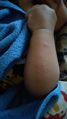 Is this chicken pox or normal rash?