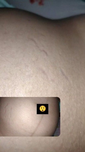 ท้องแตกตอน8เดือน