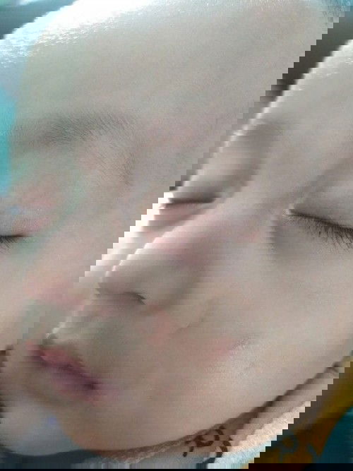 Dari bentil kecil , jadi luka seperti tersundut rokok