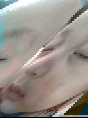 Dari bentil kecil , jadi luka seperti tersundut rokok