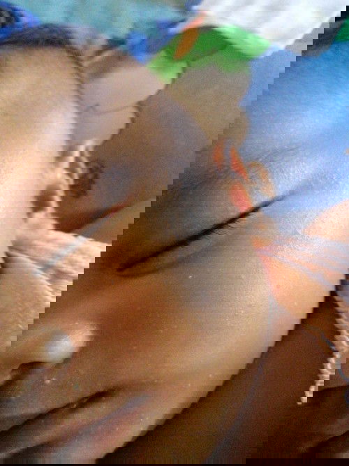 Bentol bentol di muka bayi