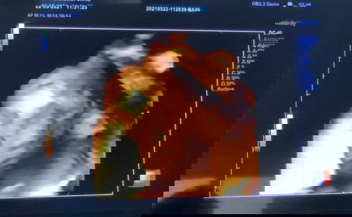 อัลตร้าซาวด์ 4 มิติตอนไหนชัดเจนสุด