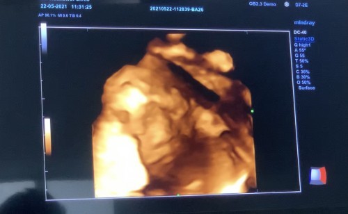 อัลตร้าซาวด์ 4 มิติตอนไหนชัดเจนสุด