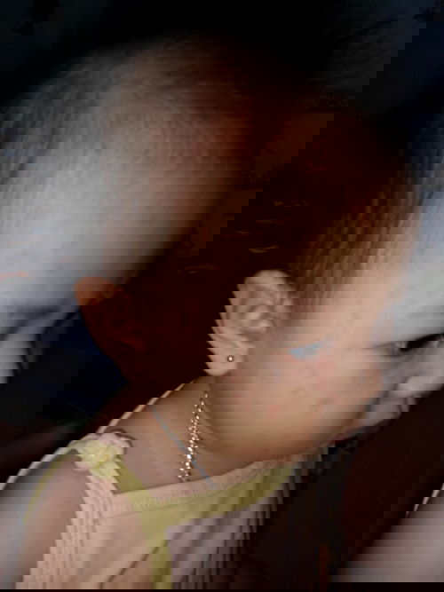 Bé nổi nốt dày khắp người