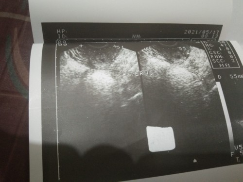 Possible po ba na sa PT is positive then sa TVS is wala makita kaht gestational sac?