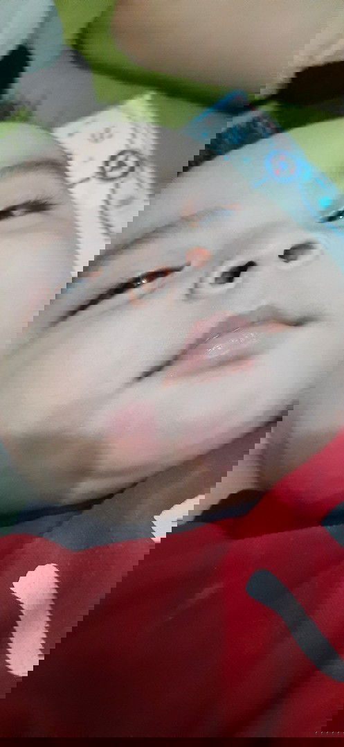 Merah di pipi dan dagu bayi