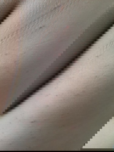 37+3 wks ผื่นขึ้น