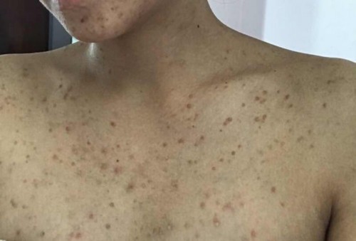 มีใครแพ้แบบนี้บ้างไหมคะ😞