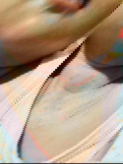 Rashes dahil sa init?