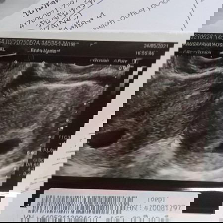 6 สัปดาห์แล้วยังไม่เห็นตัวแบบนี้เรียกท้องลมหรือเปล่าคะ