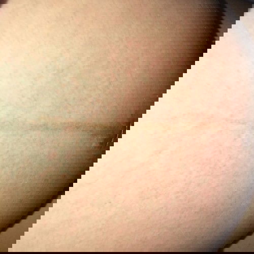 ผิวท้องแดงๆมีอาการคัน