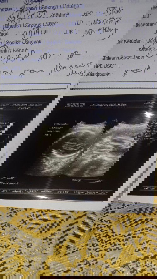 tanya donk bun ini hasil usg 30week ,benern ngk ya kata dokterny cewek,kalo iya sih Alhamdulillah ,,