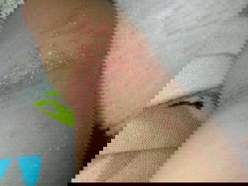 Masalah kulit newborn