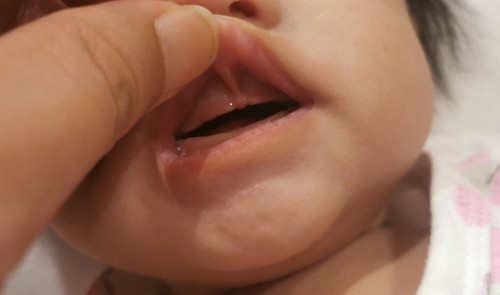 UPPER LIP TIE PO BA ITO?