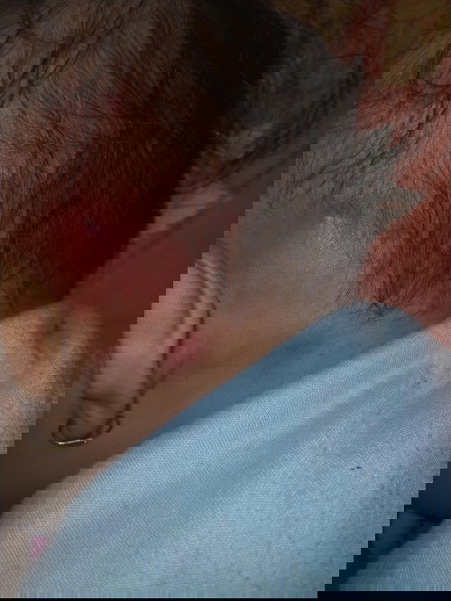 Bisul di kepala bayi