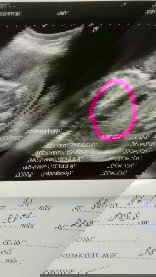 สอบถามแม่หน้อยค่ะ ท้อง34w2d